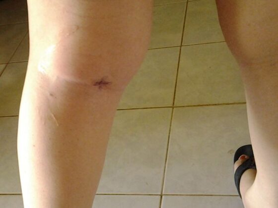 My Baker’s Cyst is Back